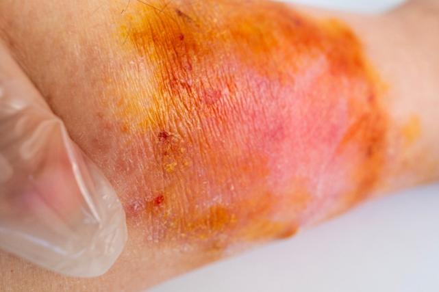 Soins de plaies Soins de plaies